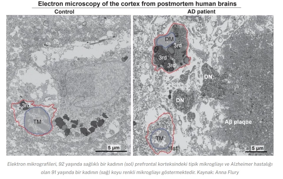 Türk Bilim İnsanlarından Alzheimer’a Yeni Umut: Beyindeki Hücresel Stresin Rolü
